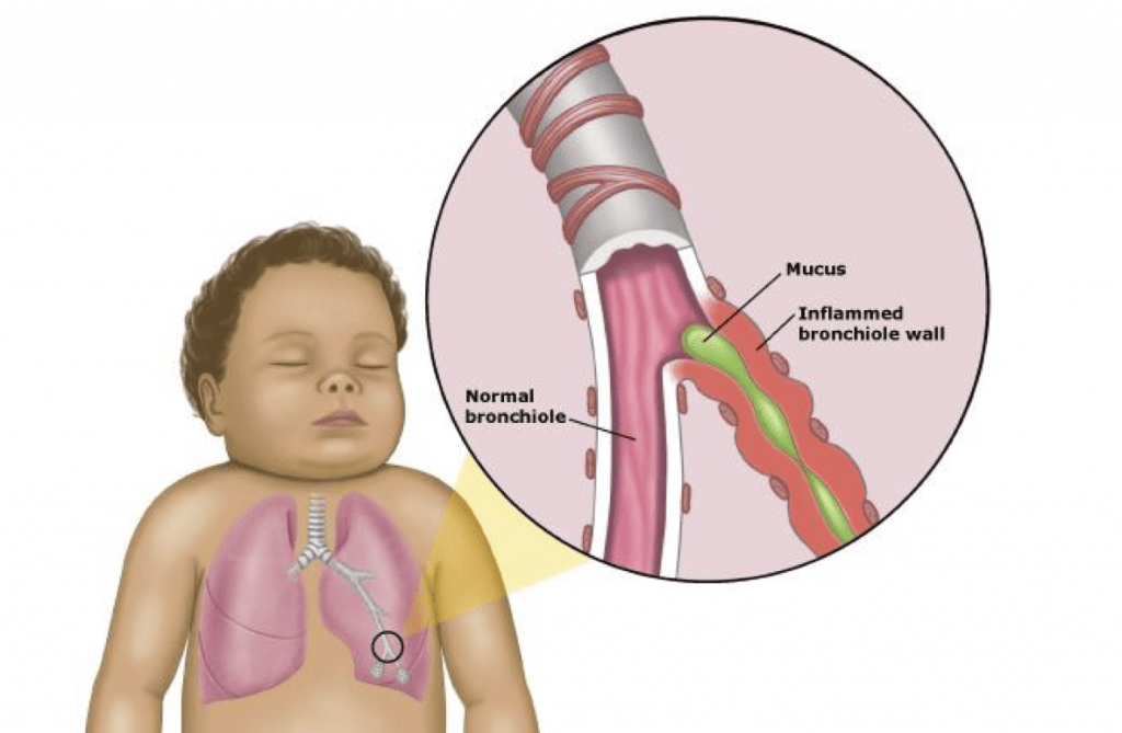 Saiba mais sobre a bronquiolite Blog Pulmolab