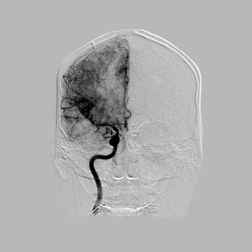 Angiogram How Doctors Look Inside Blood Vessels Using Xrays