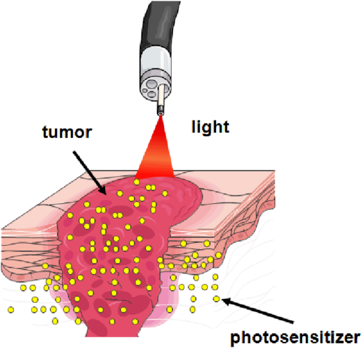 Red Laser Diodes for Photodynamic Therapy