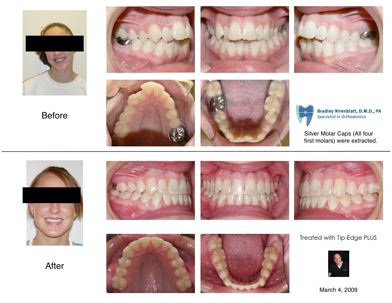 Getting All Four Wisdom Teeth Removed Teeth Poster