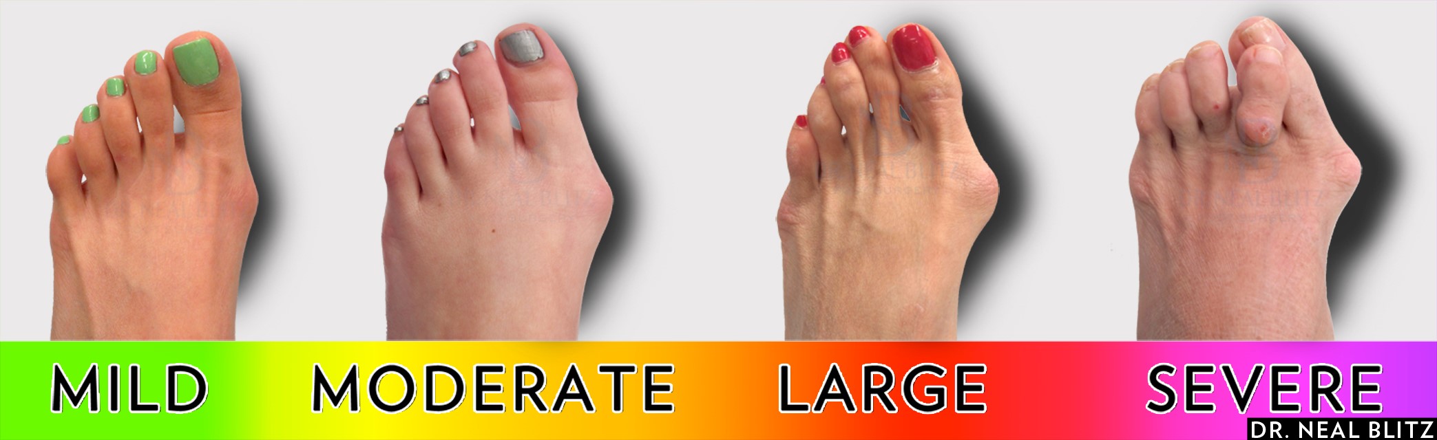 Bunions treatment and prevention Stannah
