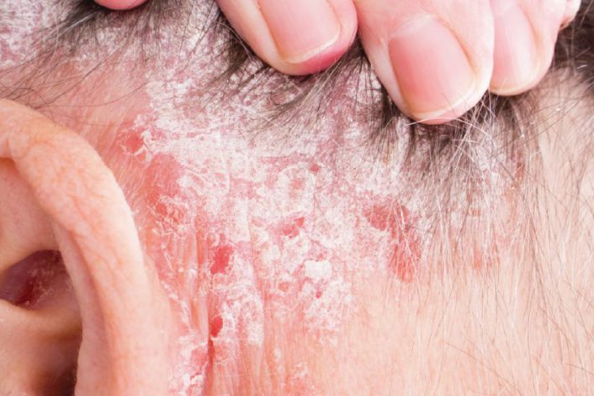 What is Psoriasis? Healthtips by TeleMe
