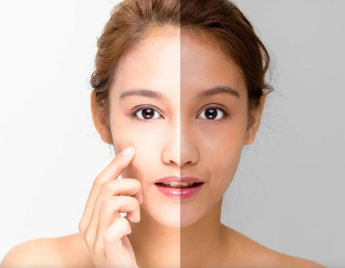 Fish Oil Benefits for Skin Whitening, Reduce Acne, and More