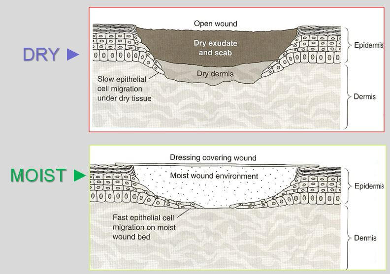 Moist Wound Dressing Archives WCEI Blog WCEI Blog