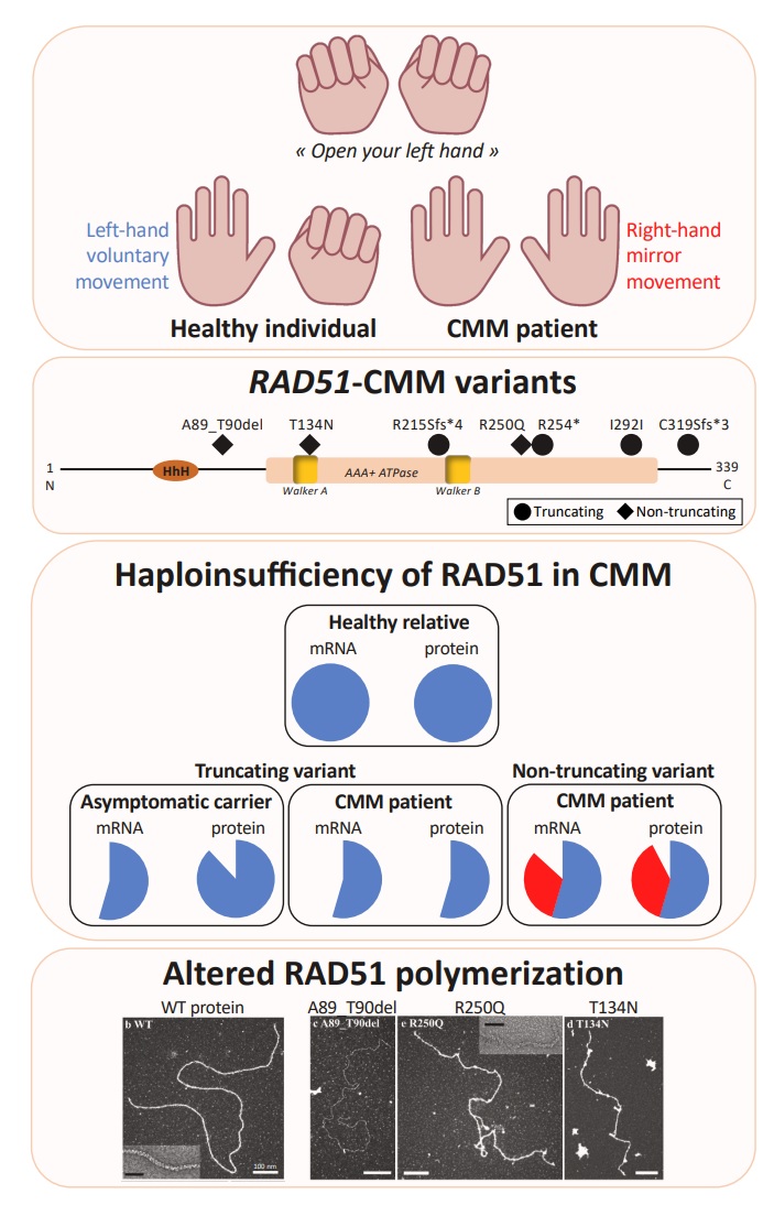 Congenital mirror movements are associated with defective polymerisation of RAD51 JMG Contact blog