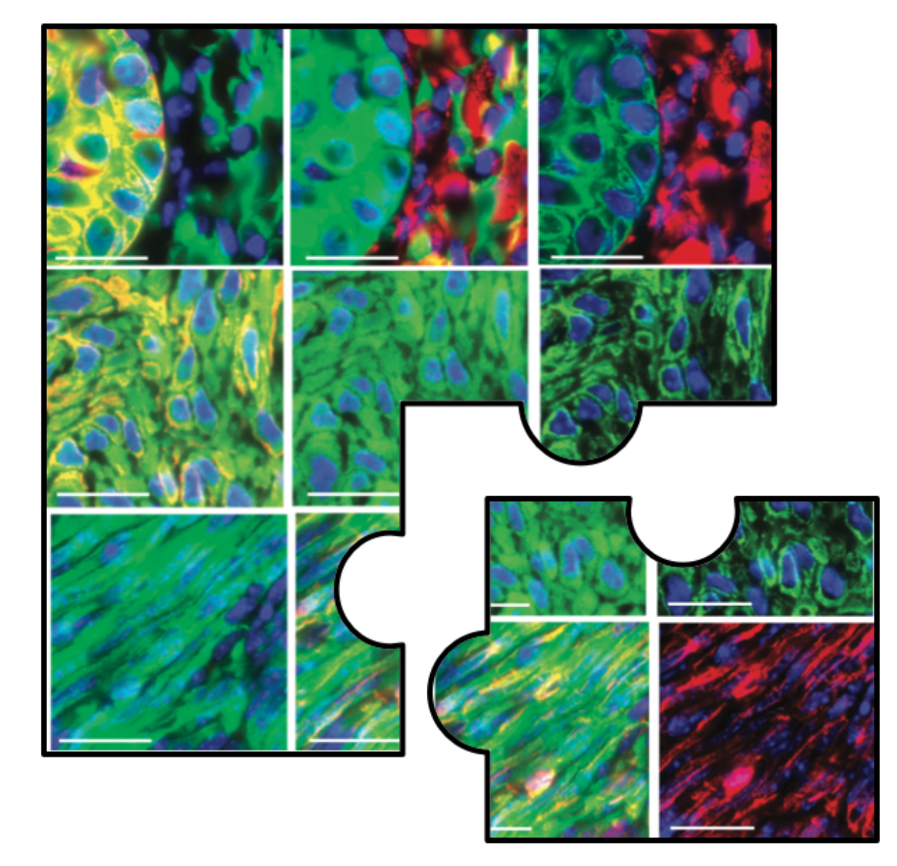 EMT Epithelialtomesenchymal transition Another piece in the puzzle