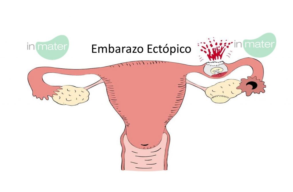 EMBARAZO ECTÓPICO Noticias inmater