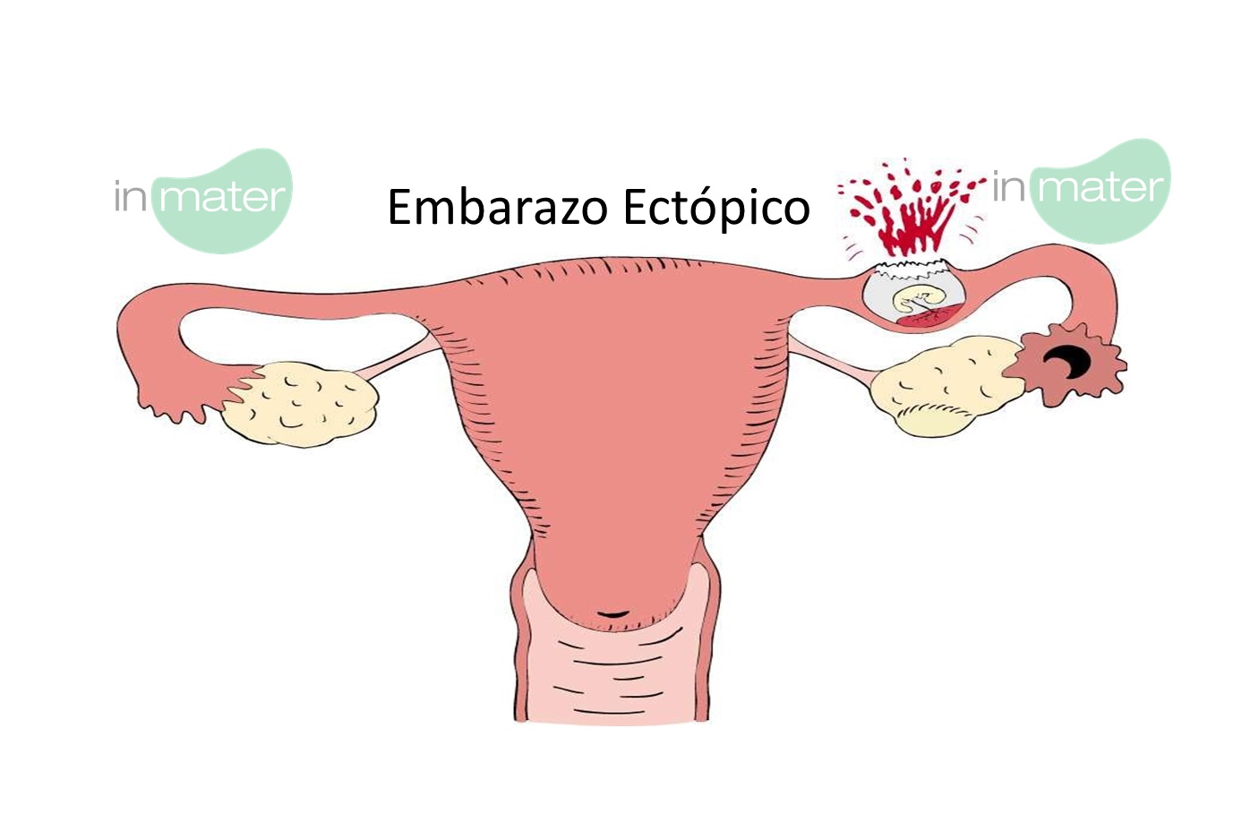 EMBARAZO ECTÓPICO Noticias inmater