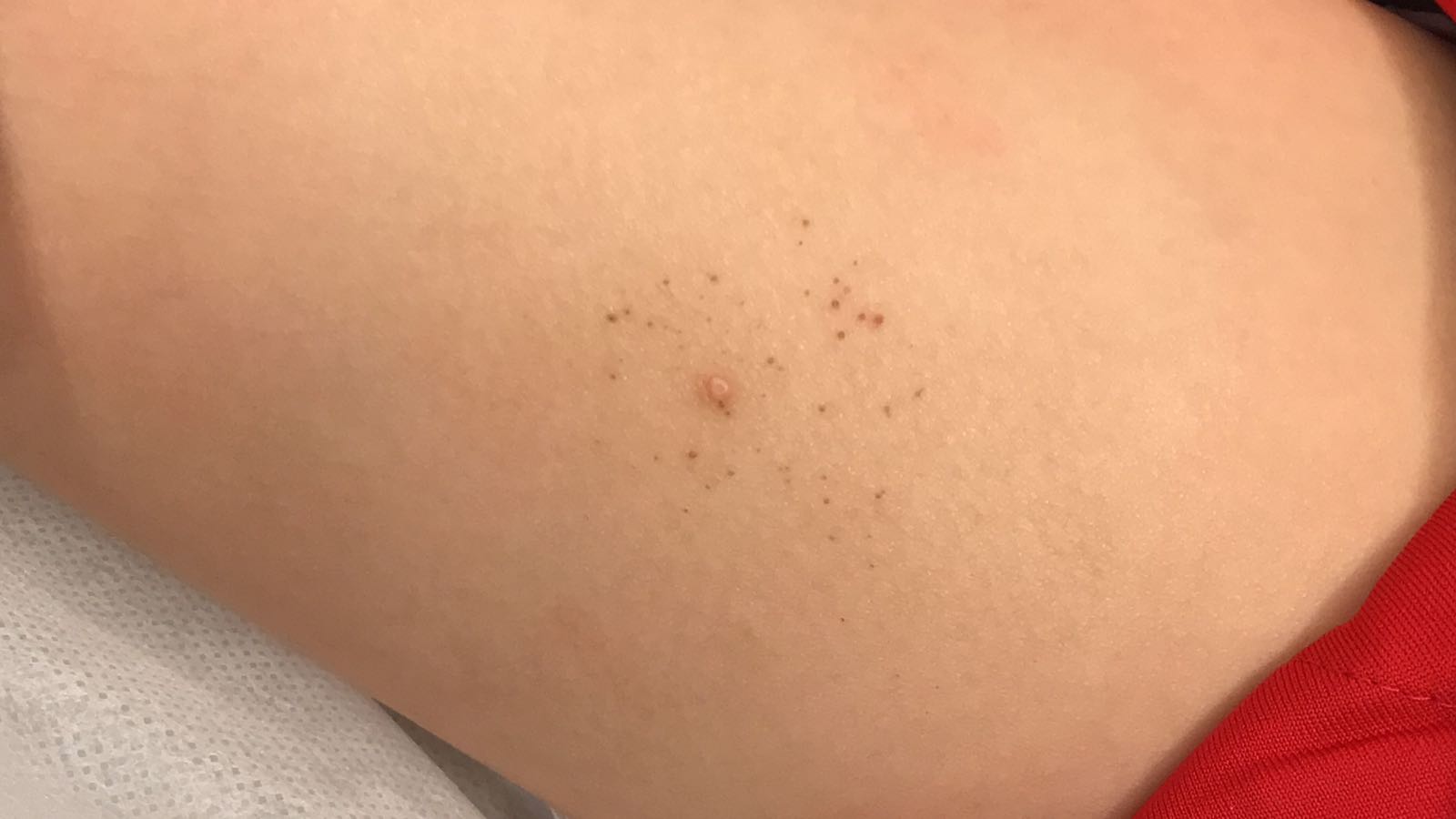 Moluscos contagiosos ¡tratar, o no tratar, esa es la