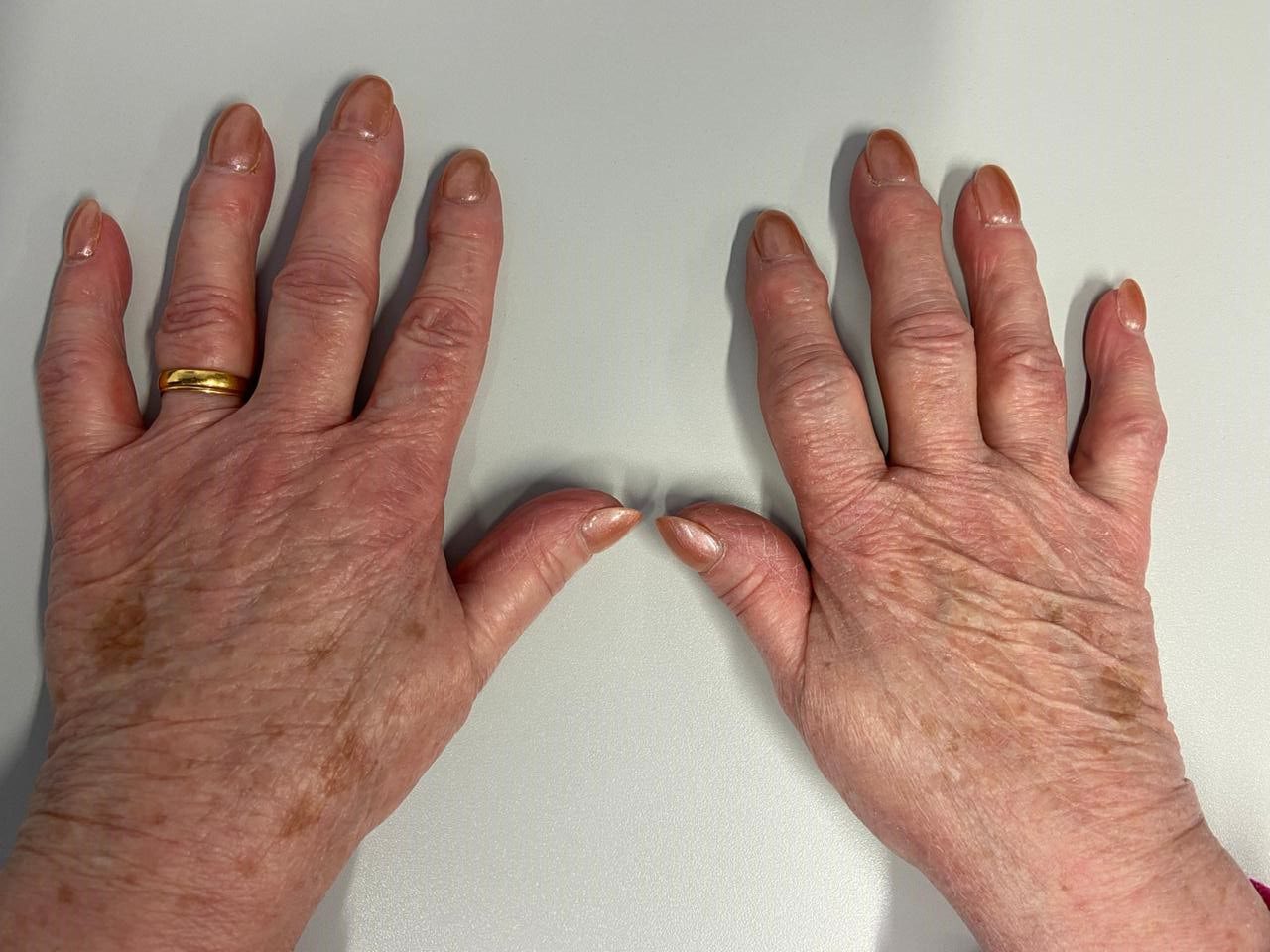 How hand osteoarthritis is associated with hand pain and function