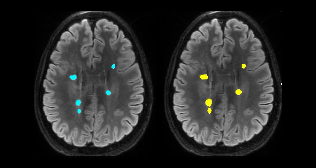AI Brings Speed, Consistency to Brain Scan Analysis NVIDIA Blog