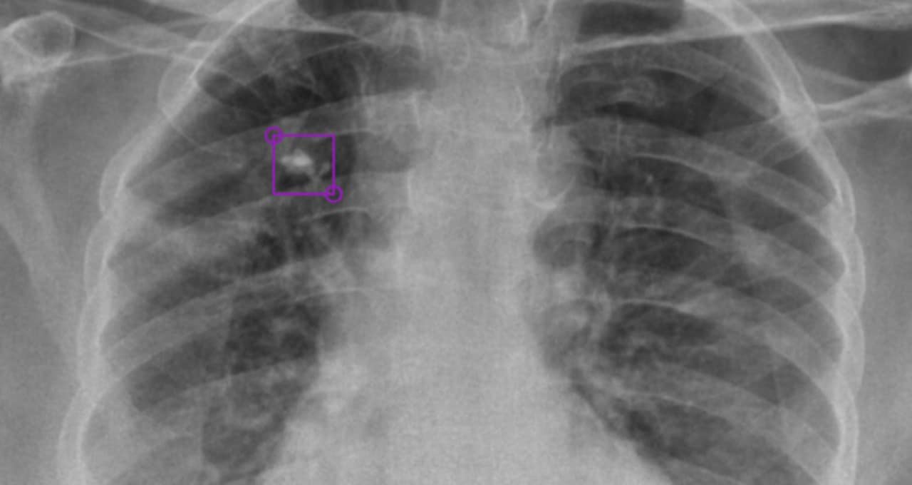 DeepTek Detects Tuberculosis from XRays with AI NVIDIA Blog