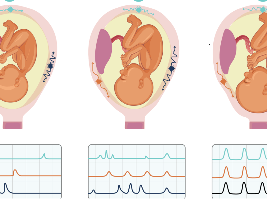The Physiological Difference Between Braxton Hicks and Labor Contractions