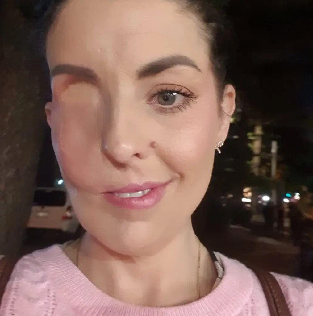 After a lifesaving procedure, a woman who lost her eye describes how