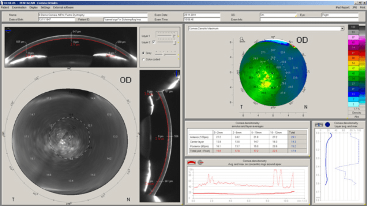 Oculus Pentacam A Complete Purchasing and User Guide Blue River