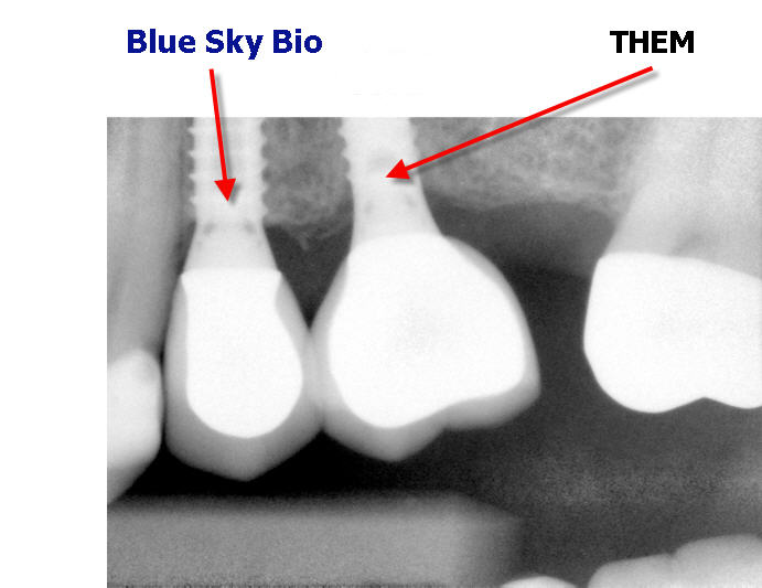 Enhanced Occlusal Threads Blue Sky Bio
