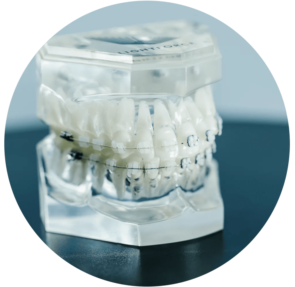 LightForce Orthodontics 3D Printed Custom Braces Blue Wave Orthodontics