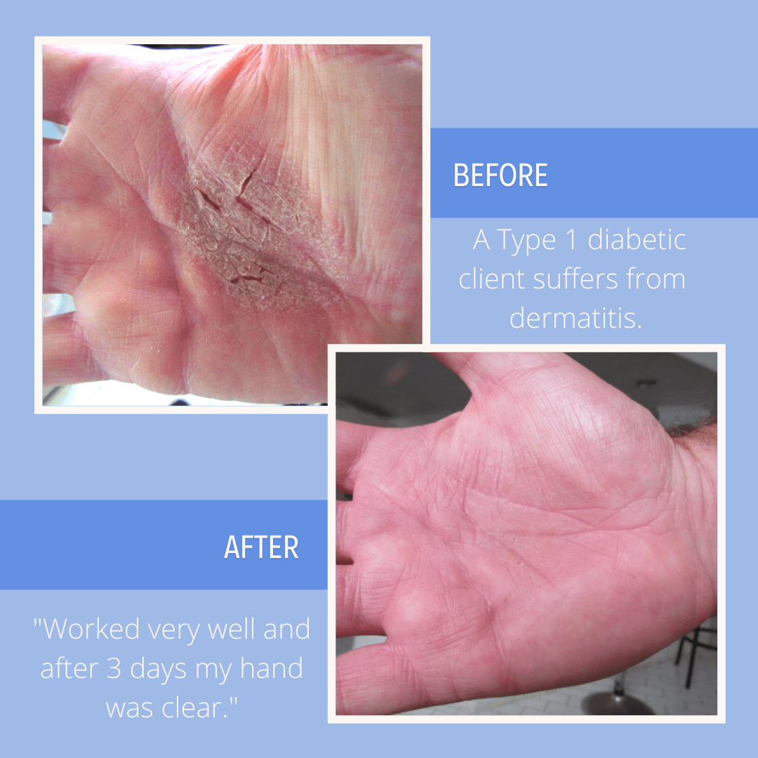 10 Diabetic Skin Conditions Part 1 BluLyte