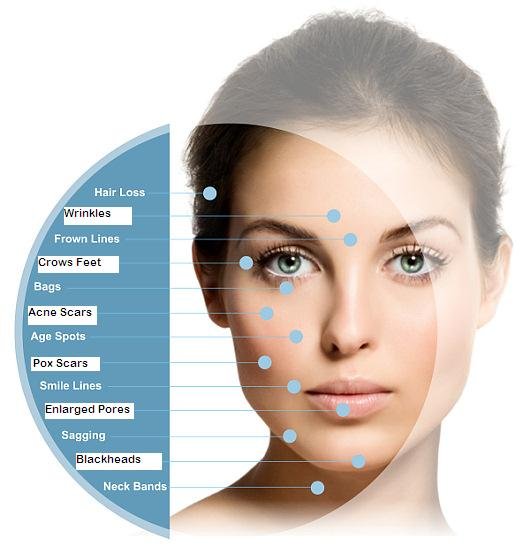 Microneedle face mesotherapy in Bournemouth, Poole and Christchurch