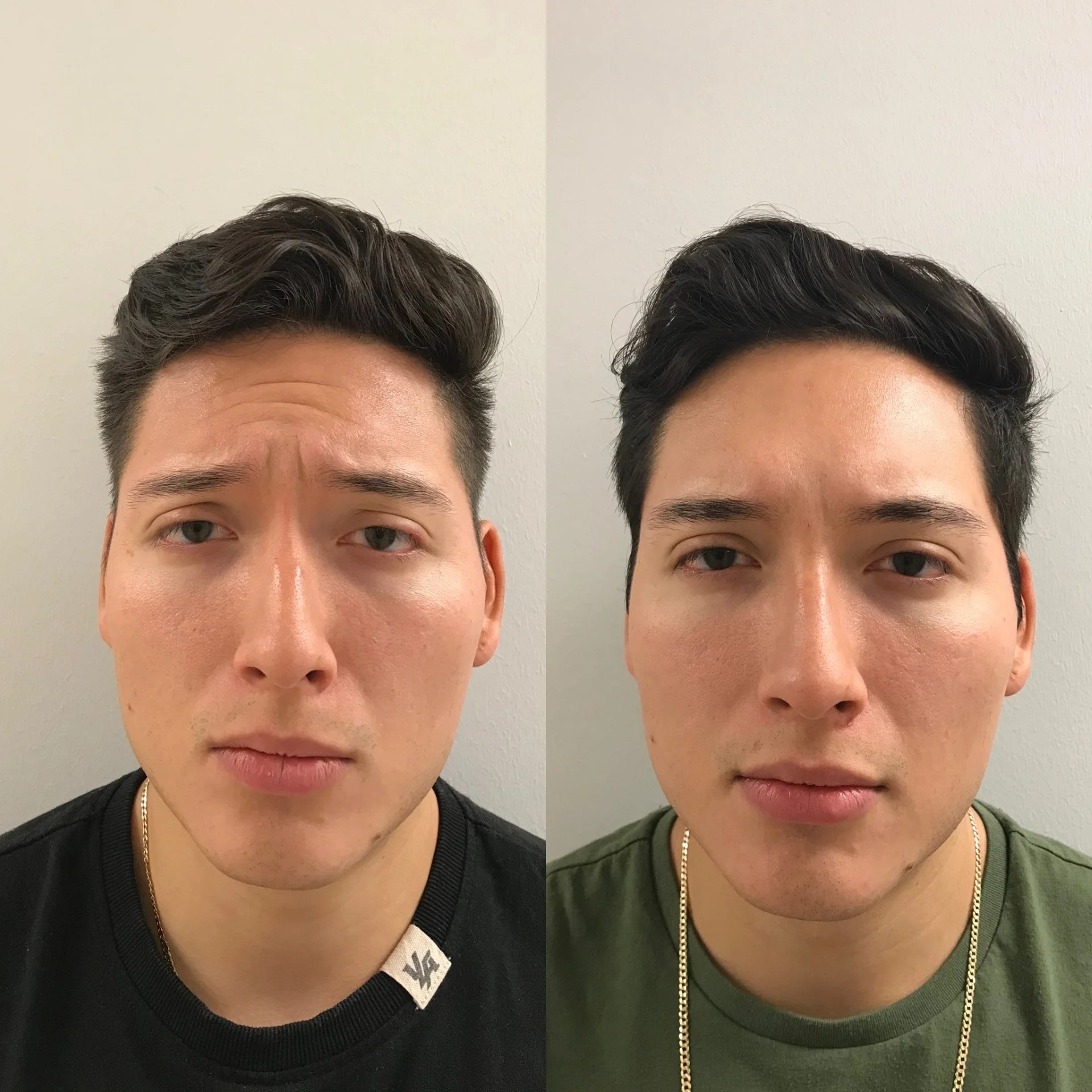 NeuroModulators (Dysport) BLUSH AESTHETICS & WELLNESS