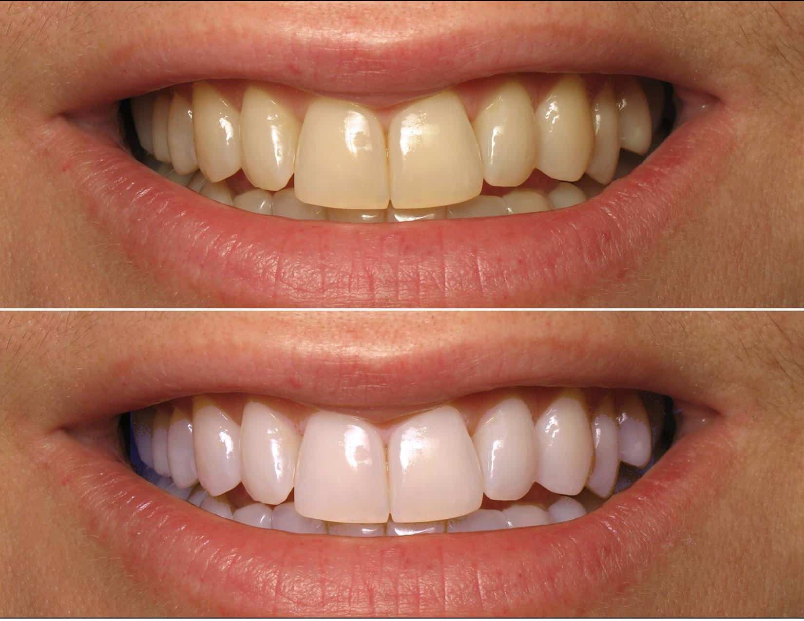 Best ways to whiten your teeth at home