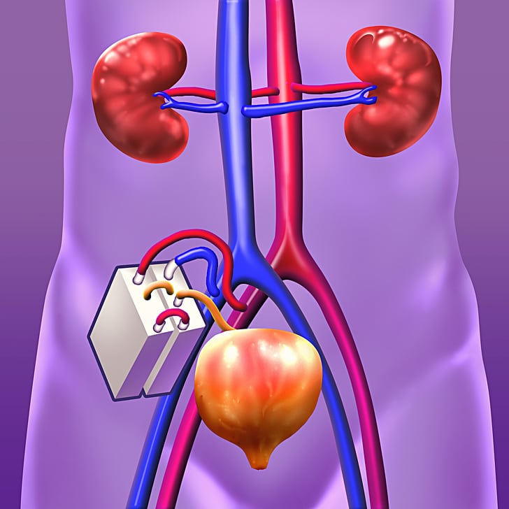 Scientists developed bionic kidney