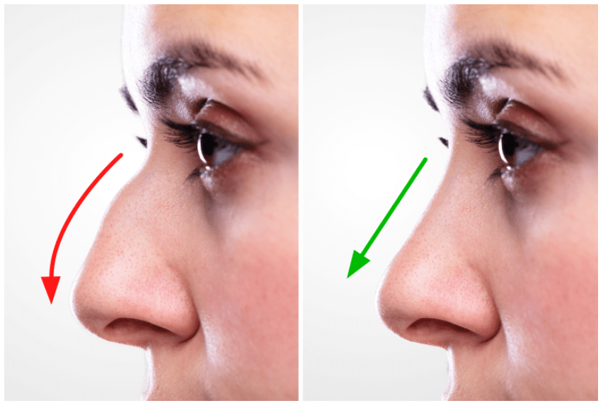 Are you a Suitable Candidate for Rhinoplasty Procedure_ Spices Land eg