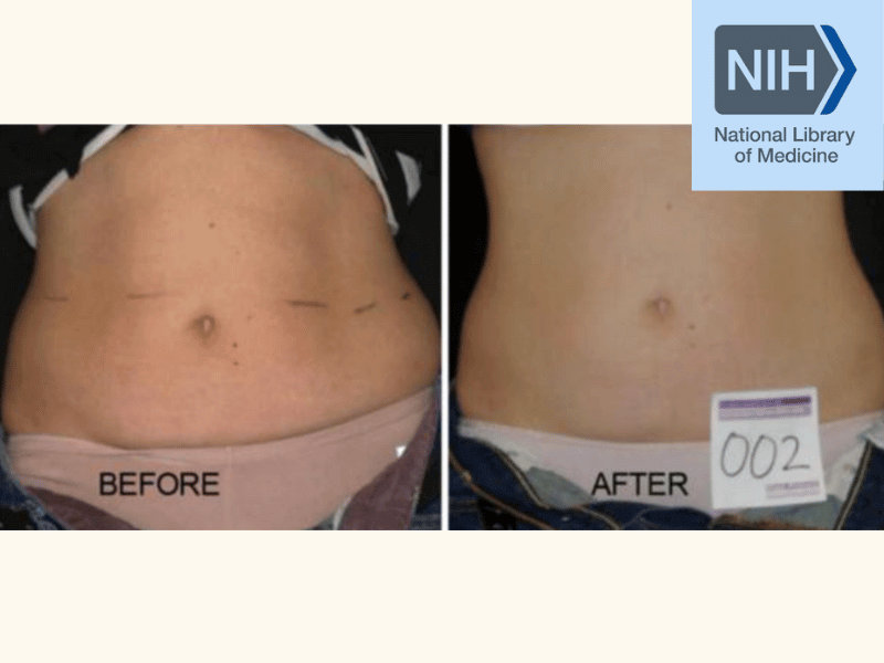 Bodcor Body Contouring Clinical Studies Proven Results