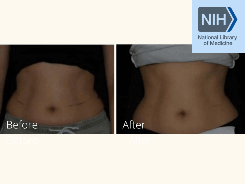 Bodcor Body Contouring Clinical Studies Proven Results