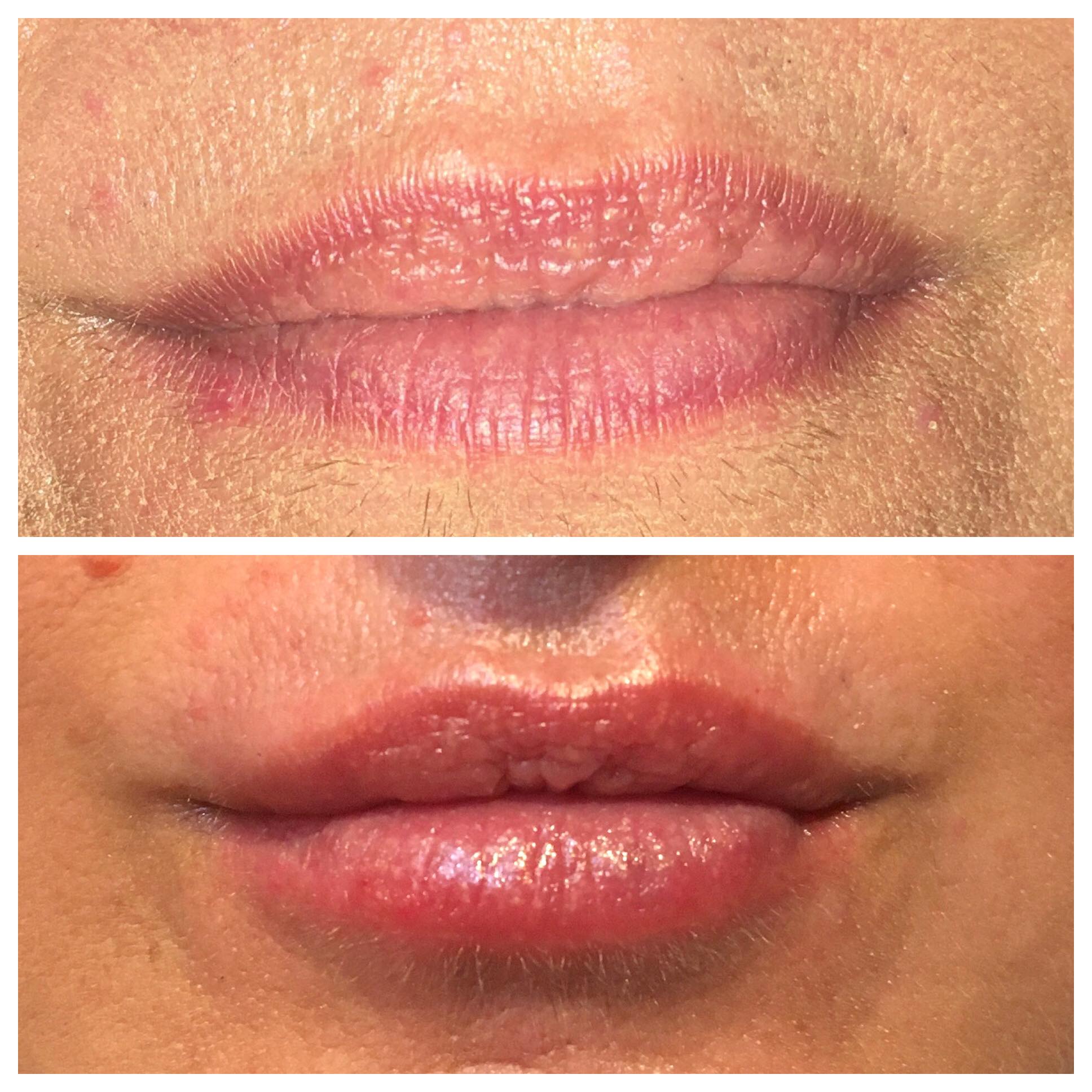No Needle Lip Filler Beauty Treatments Plymouth