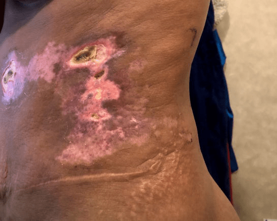 How To Treat a Lipo/Faja Burn? Body by Yashi