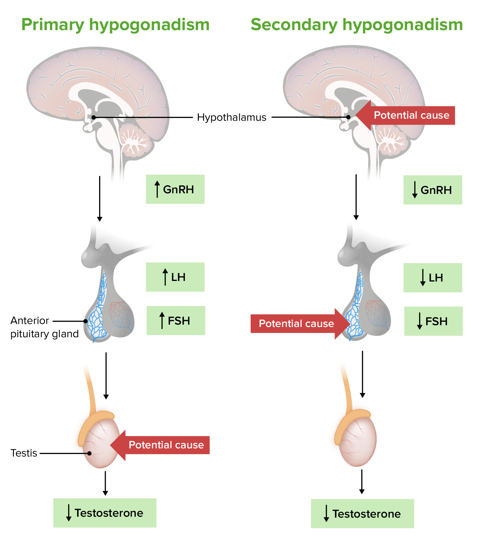 What is the difference between primary and secondary hypogonadism