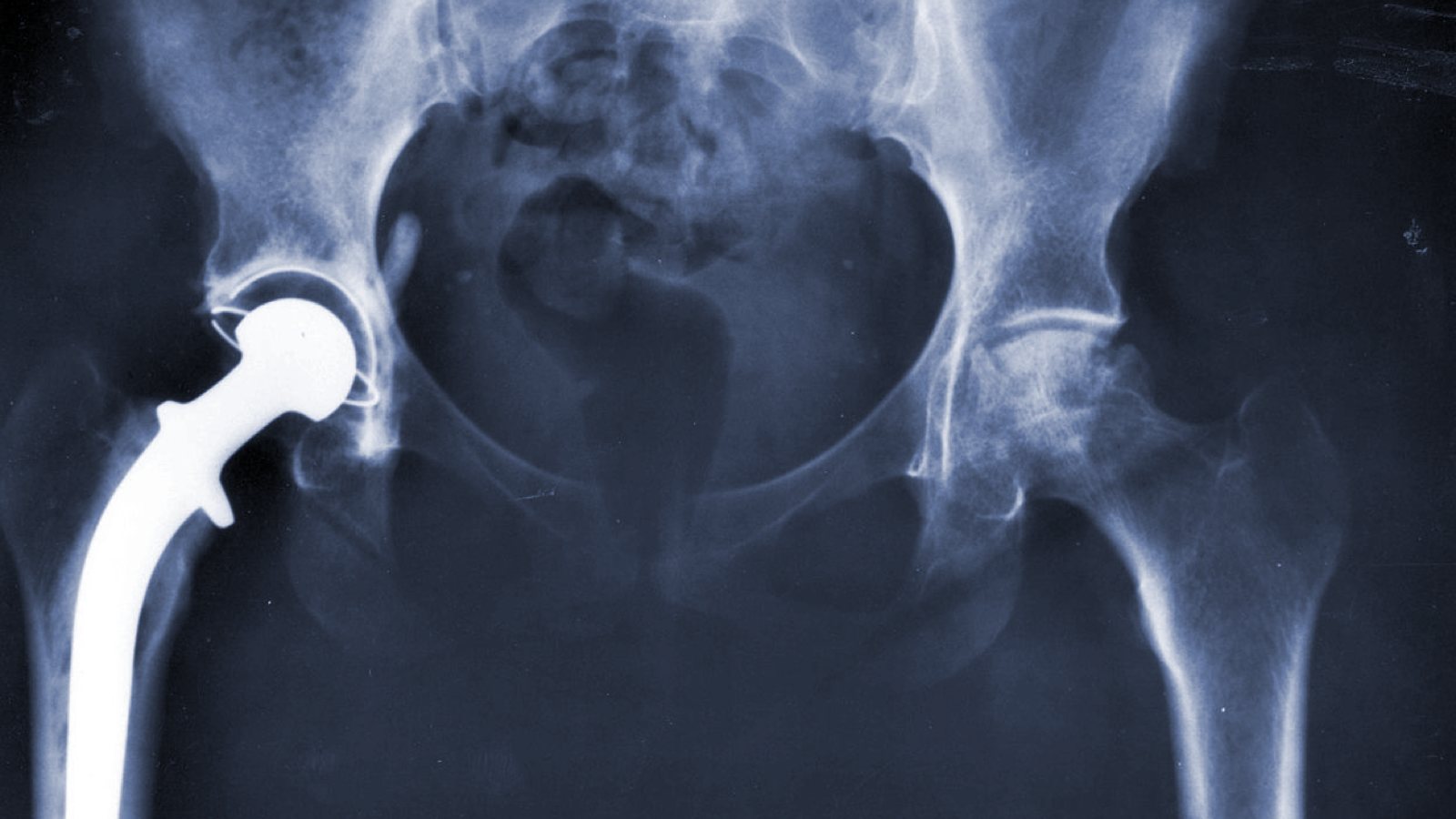 Sensitivity and Allergy to Metals in a Knee Replacement