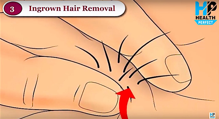 Weird Video On How To Remove Ingrown Pubic Hair Boing Boing