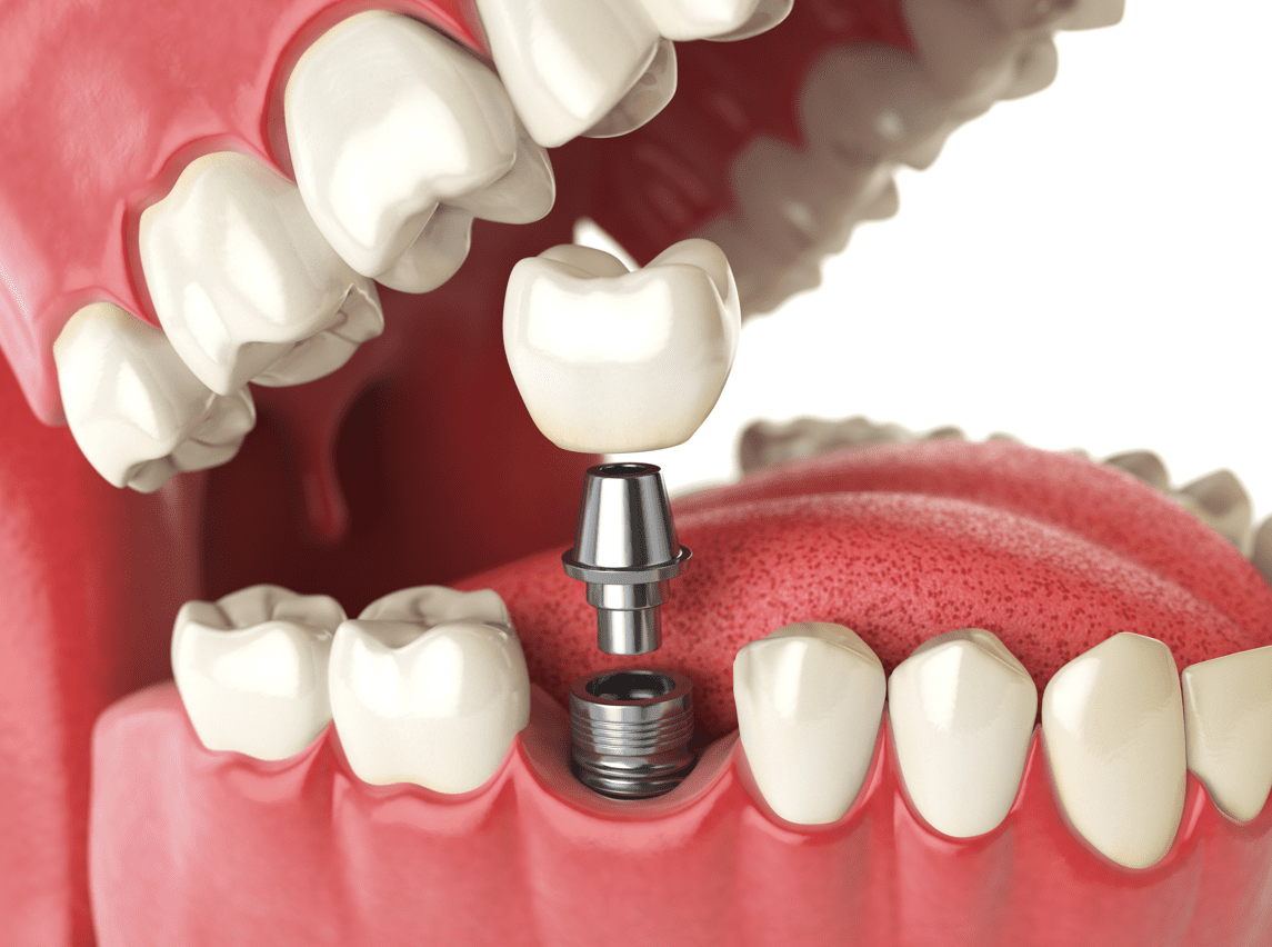 Dental Implants VS Dentures in Boise, Idaho Prevention Dental Boise
