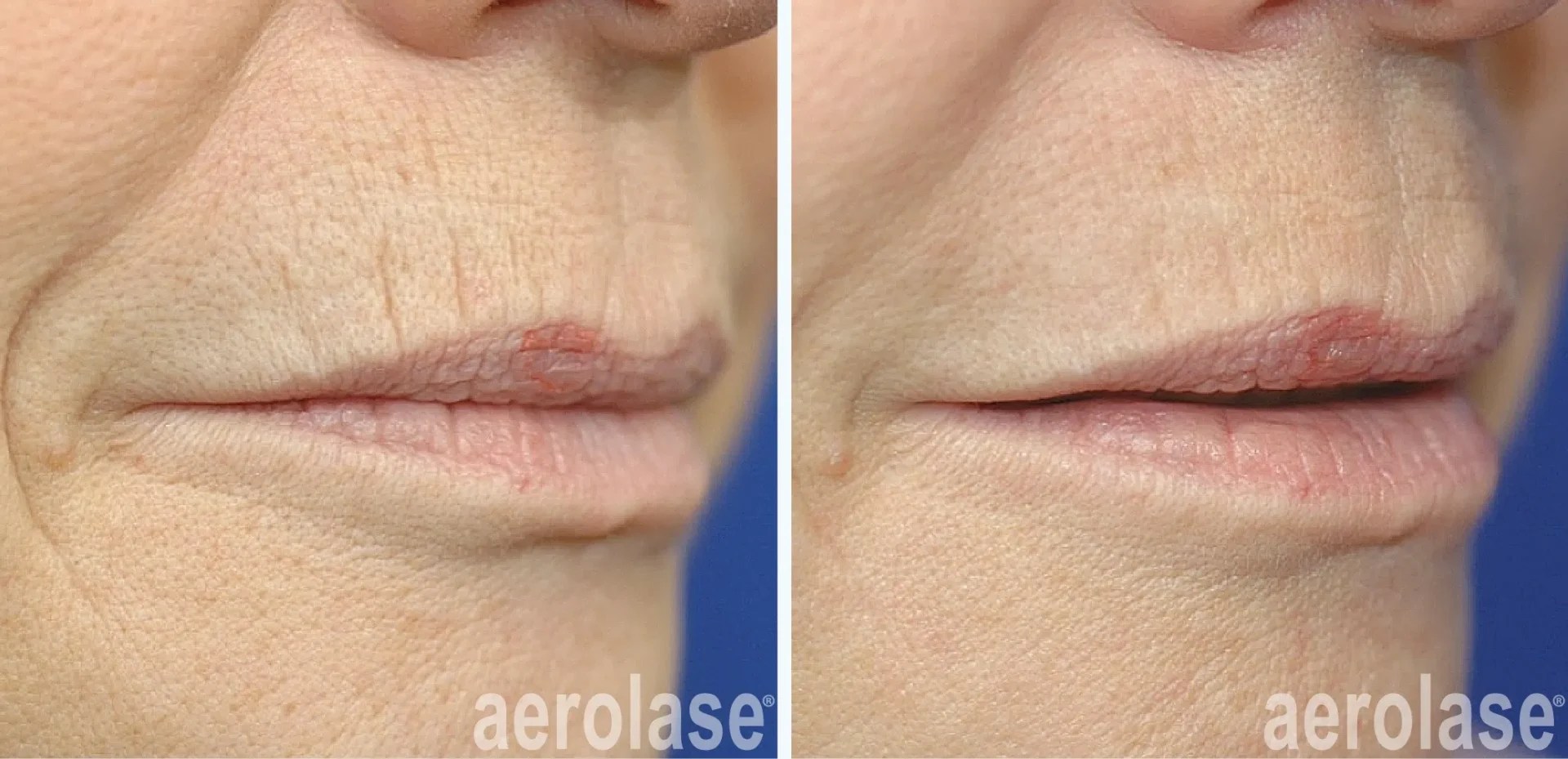 Aerolase Neo Elite Bolus Med Spa