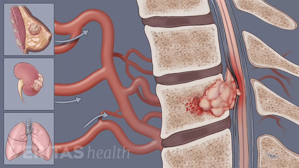 好痛! 聊聊癌症的脊椎轉移 ABC 骨科中心