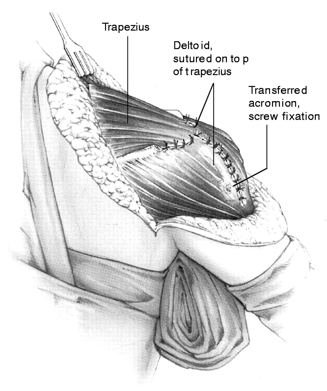 Trapezius transfer in brachial plexus palsy Bone & Joint