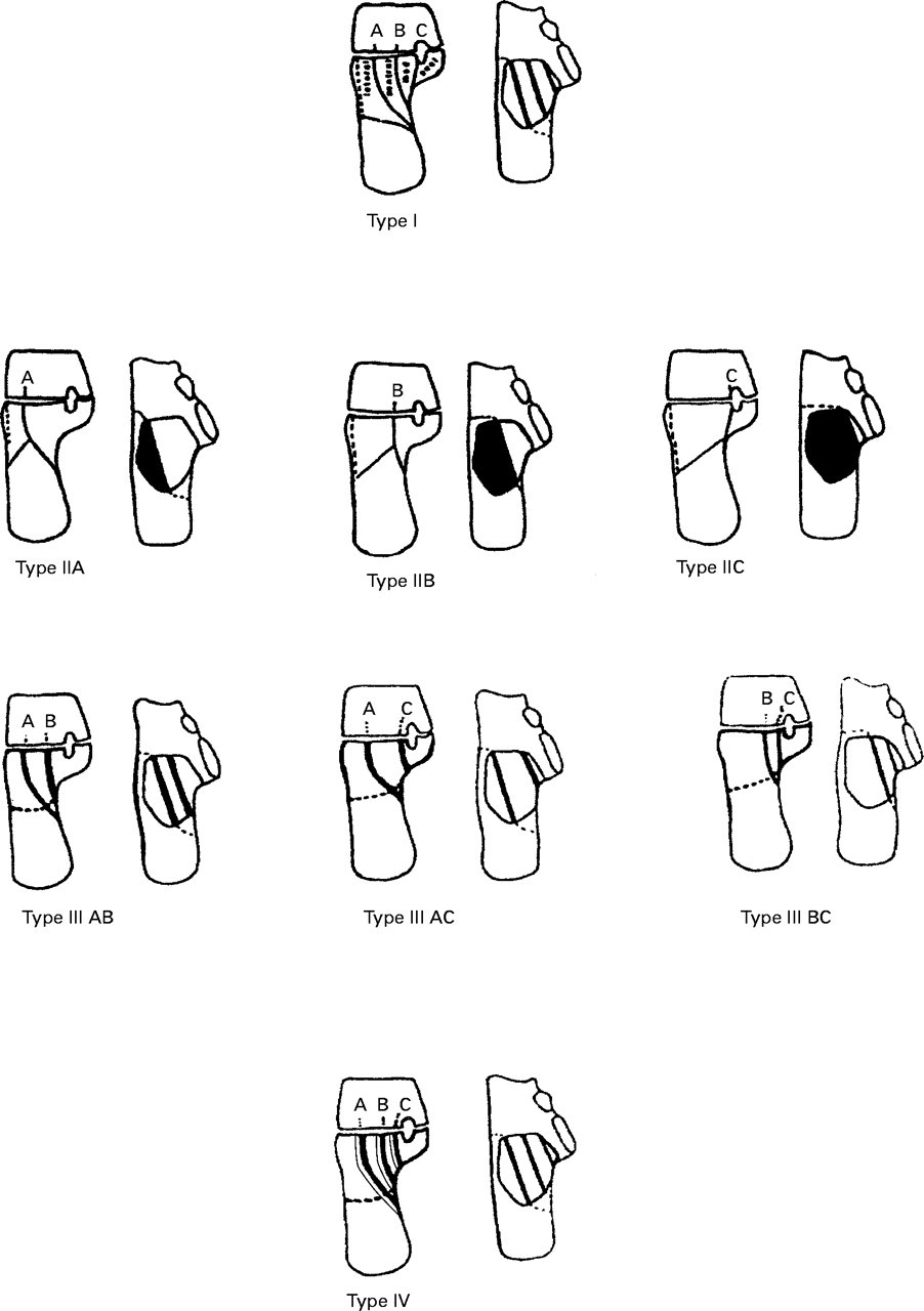 Sanders classification of fractures of the os calcis Bone & Joint