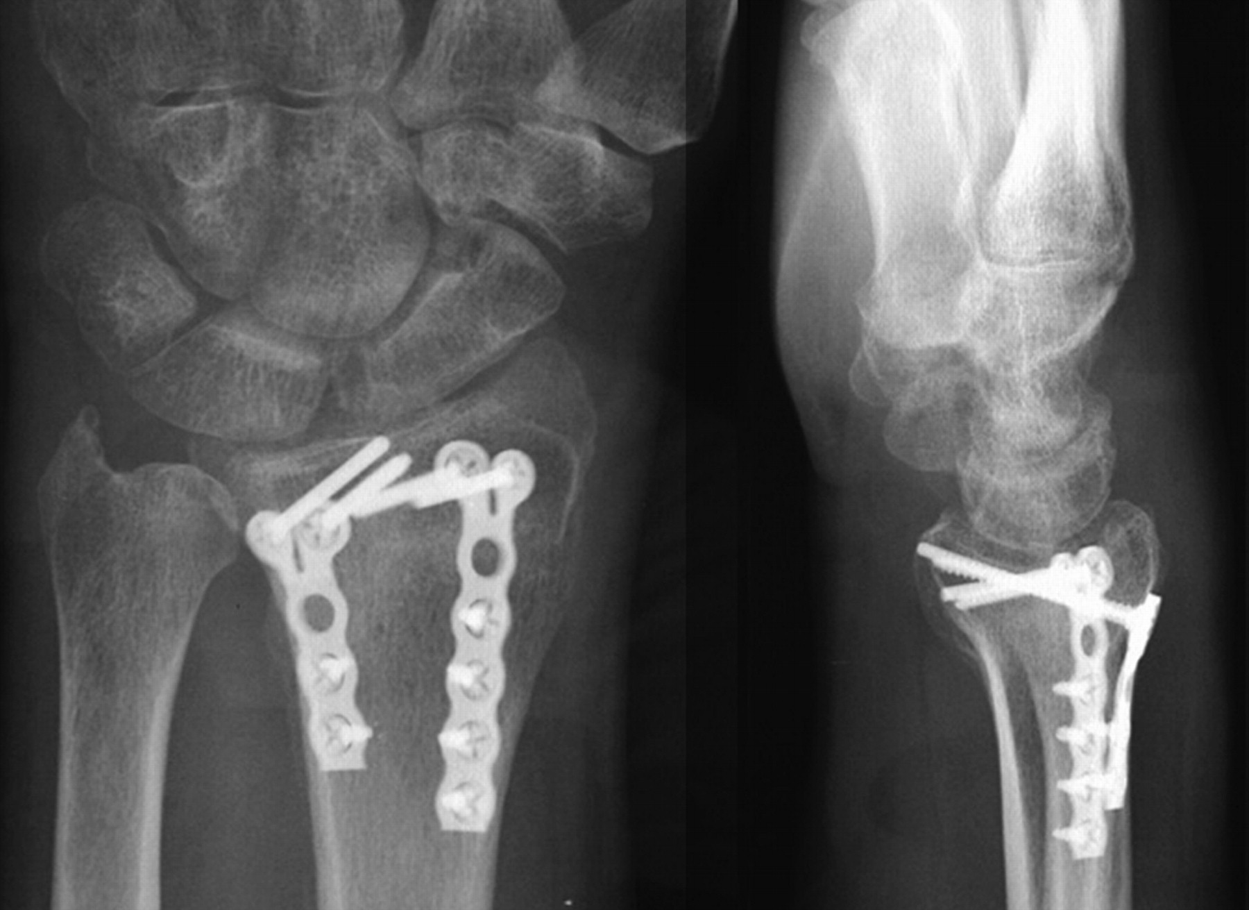 Indirect reduction and percutaneous fixation versus open reduction and