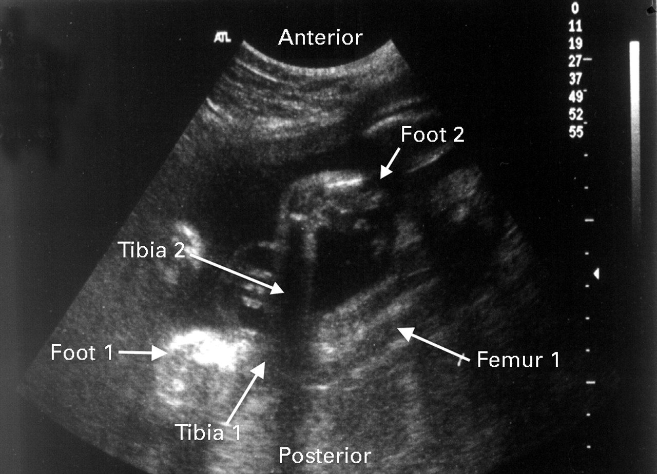 Club Foot Ultrasound