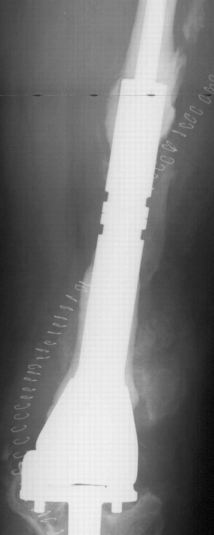 Noninvasive distal femoral expandable endoprosthesis for limbsalvage