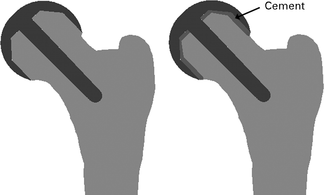 Biomechanics of the Birmingham hip resurfacing arthroplasty Bone & Joint