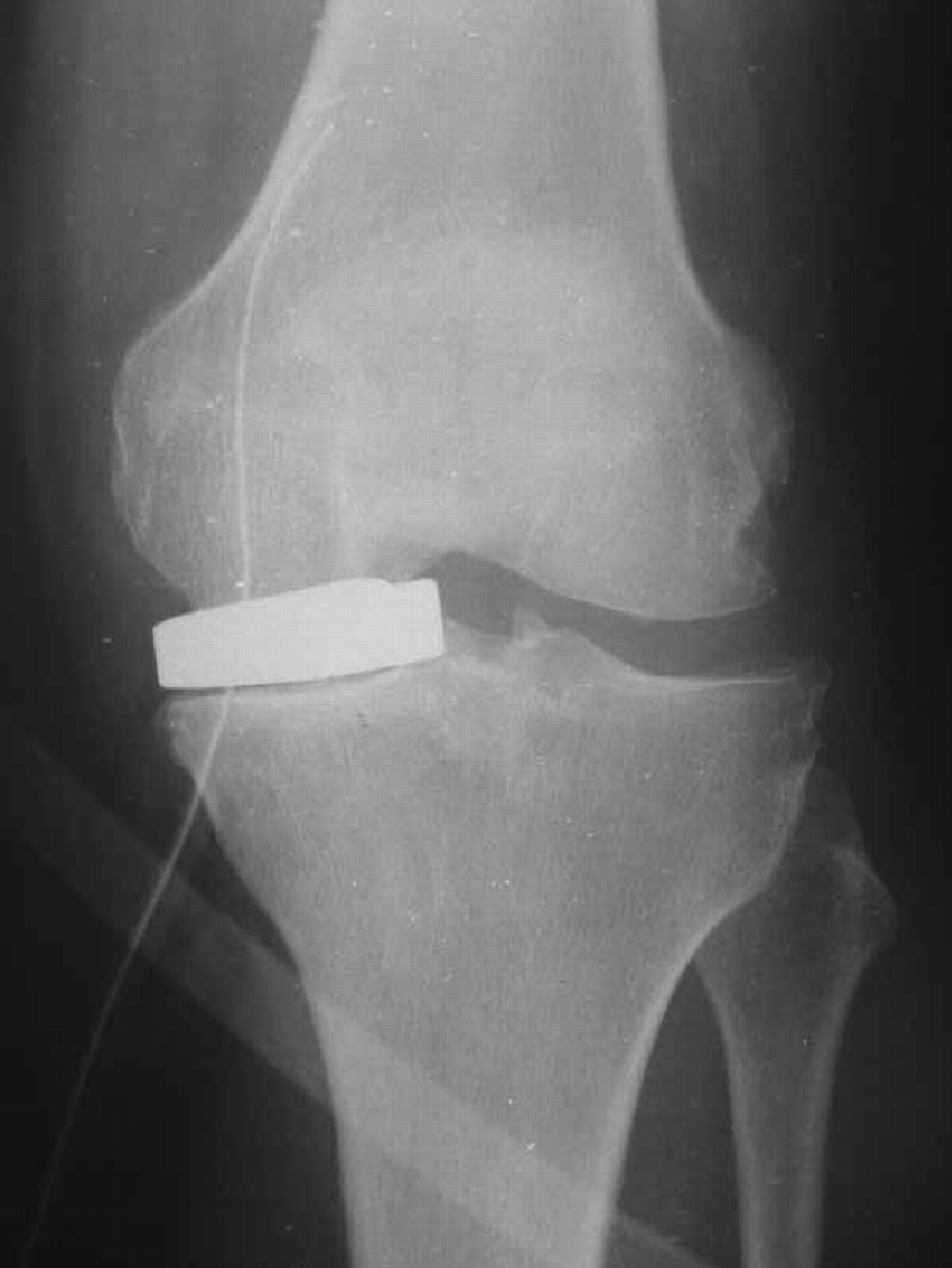 The Unispacer knee implant Bone & Joint
