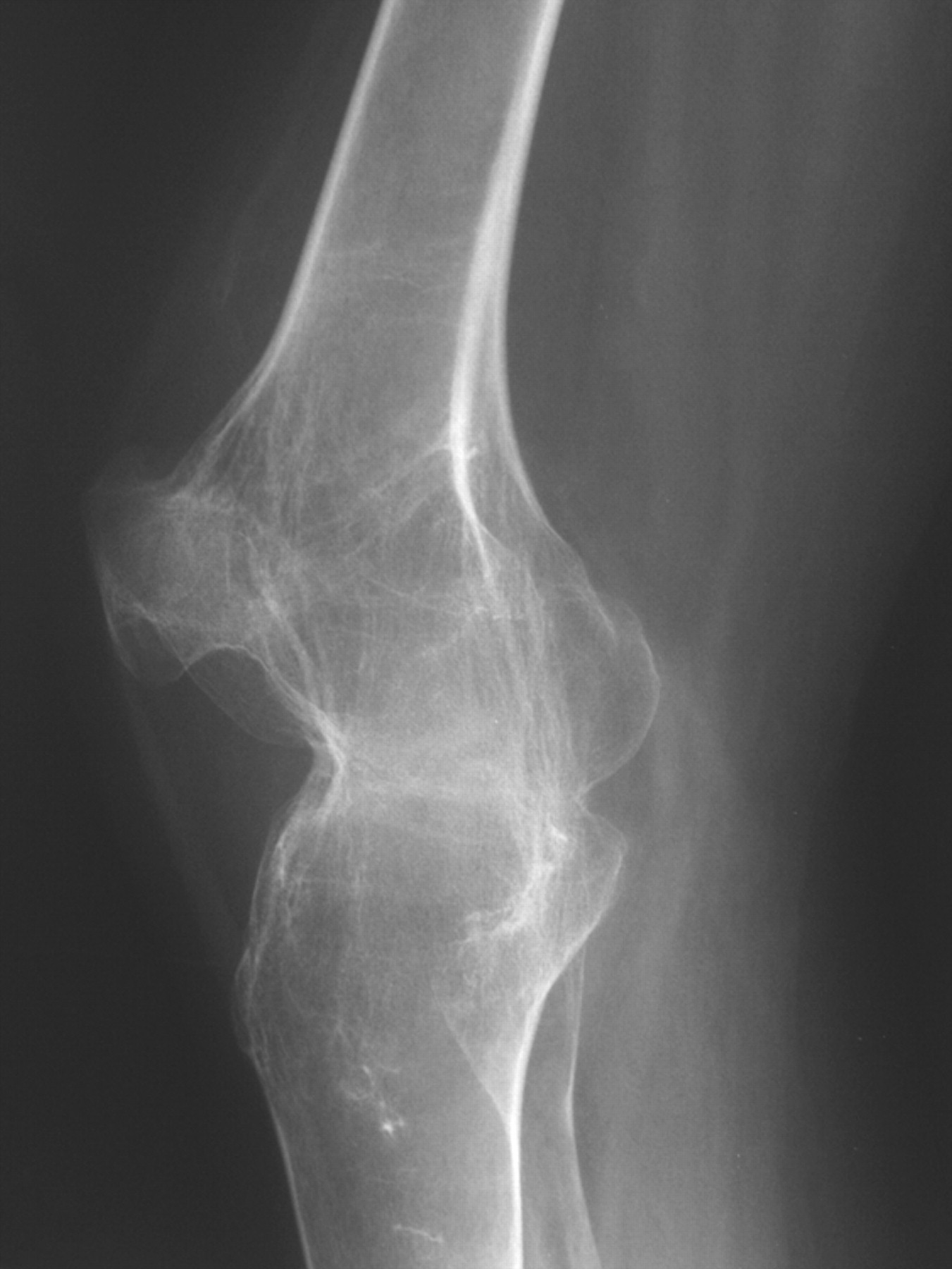 Conversion of bilateral hip and knee ankylosis to total joint