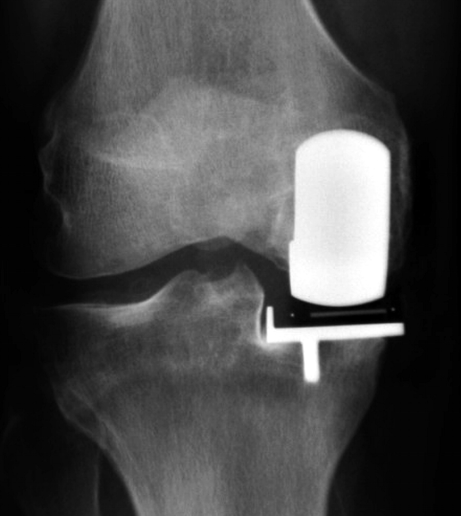Cementless Oxford knee replacement shows reduced