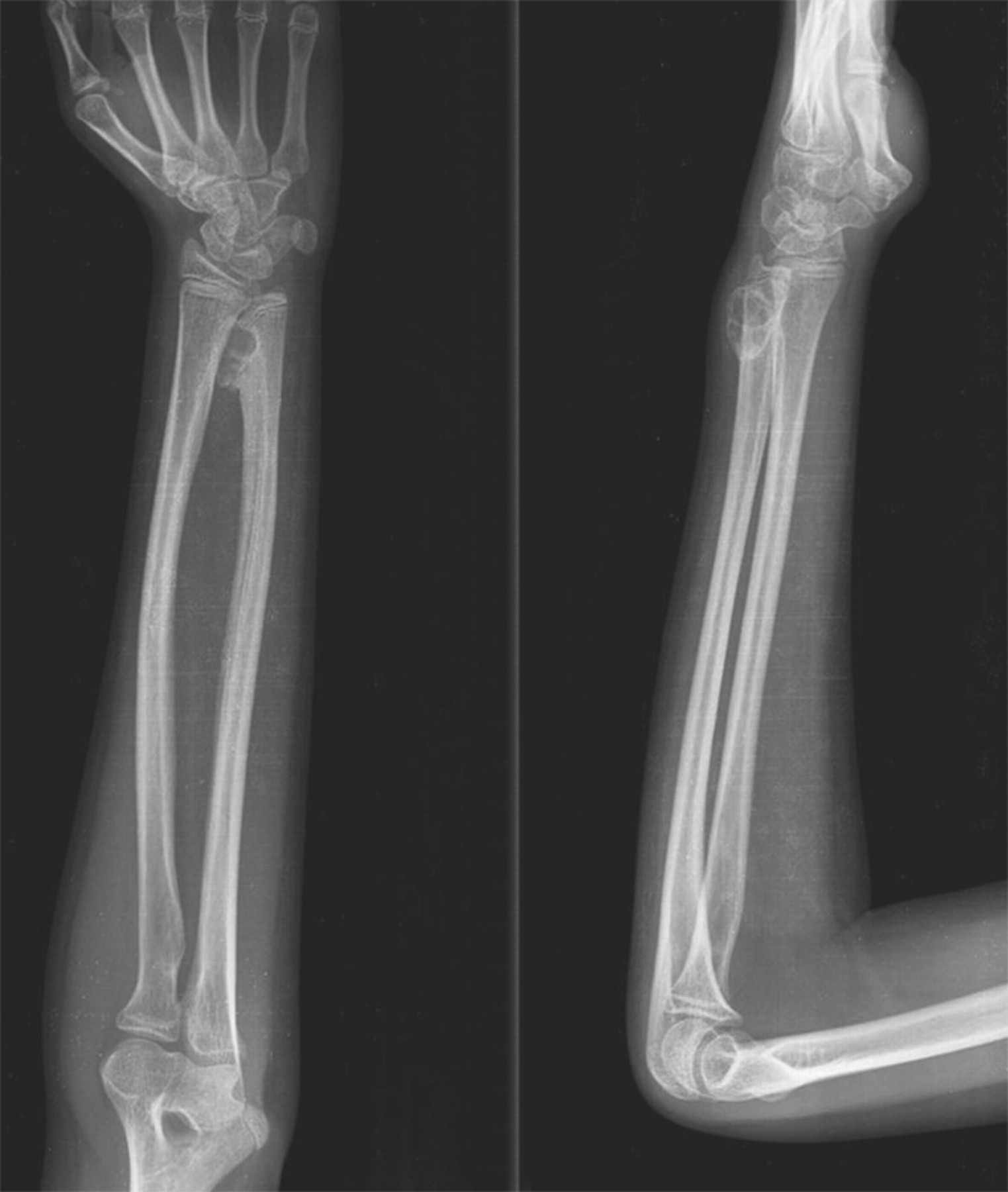 Florid reactive periostitis of the forearm bones in a child Bone & Joint