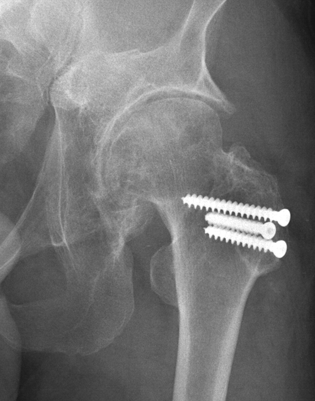 The Chiari pelvic osteotomy for patients with dysplastic hips and poor