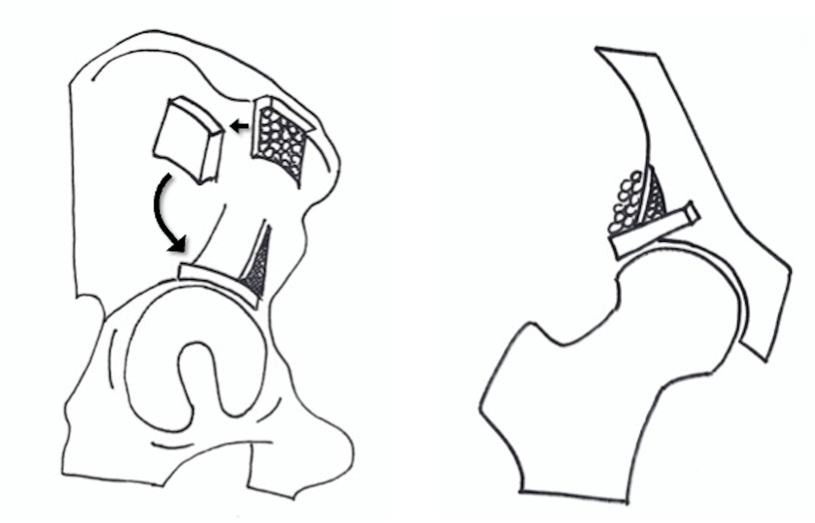 The modified Spitzy shelf acetabuloplasty for the dysplastic hip Bone