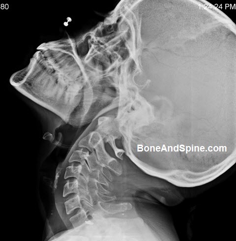 Flexion Extension Xrays of Cervical Spine | Bone and Spine